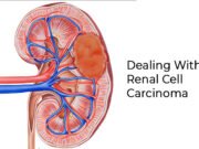Positive Changes to Help You Deal With Renal Cell Carcinoma Positive Changes to Help You Deal With Renal Cell Carcinoma - BLK Hospital