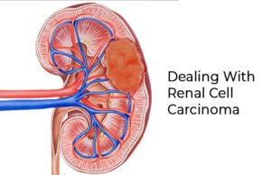 Positive Changes to Help You Deal With Renal Cell Carcinoma Positive Changes to Help You Deal With Renal Cell Carcinoma - BLK Hospital